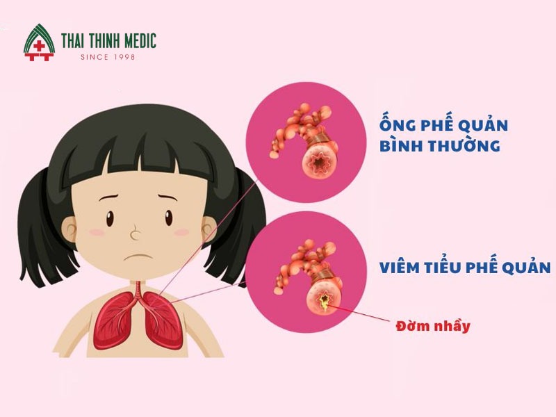 vi-khuan-gay-viem-phe-quan-cap
