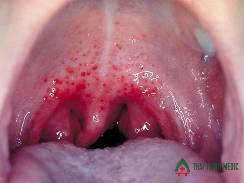 viem-hong-do-virus