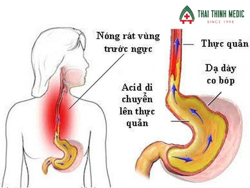 viem-hong-do-trao-nguoc-da-day