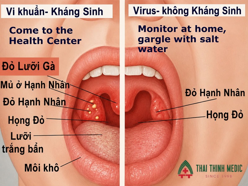 phan-biet-viem-hong