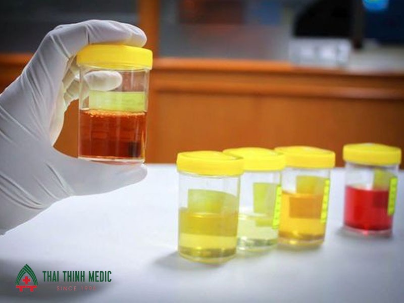 mat-nuoc-do-tieu-chay-nuoc-tieu-dam