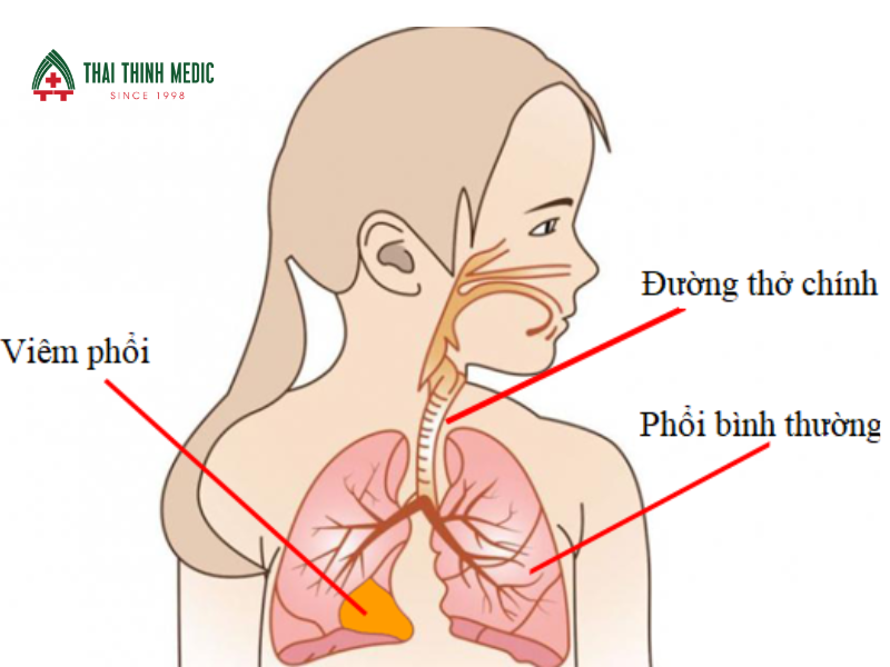 viem-phe-quan-o-tre-em-co-nguy-hiem-khong-viem-phoi