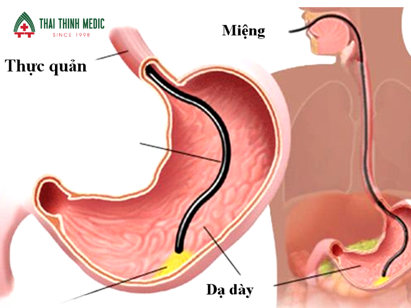 noi-soi-da-day-phat-hien-benh-gi-viem-da-day