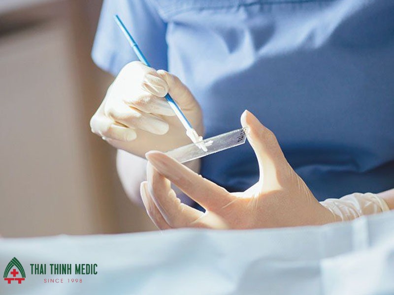 pap-smear-tam-soat-ung-thu-co-tu-cung