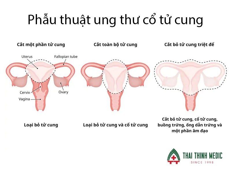 ung-thu-co-tu-cung-co-chua-duoc-khong-anh-huong-sinh-san-khong