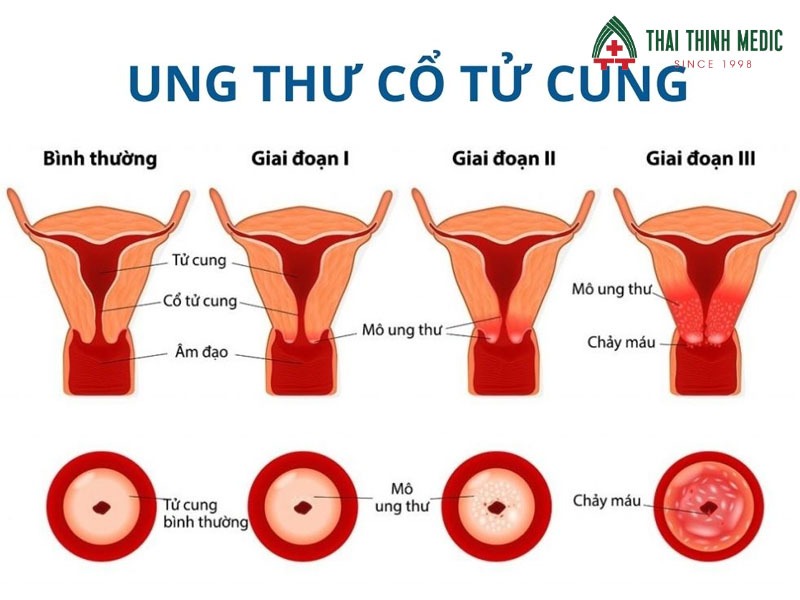 ung-thu-co-tu-cung-co-chua-duoc-khong-giai-doan
