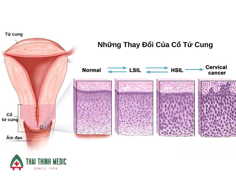 cach-doc-ket-qua-tam-soat-ung-thu-co-tu-cung-hsil