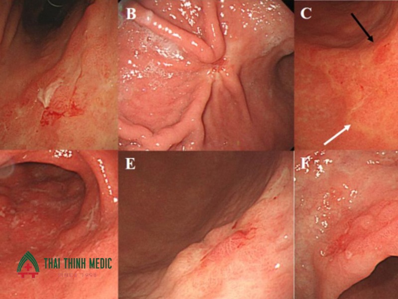 noi-soi-da-day-co-phat-hien-ung-thu-khong-ung-thu-giai-doan-som