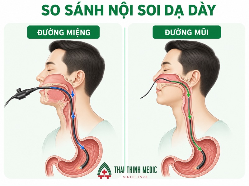 noi-soi-da-day-khong-gay-me-so-sanh