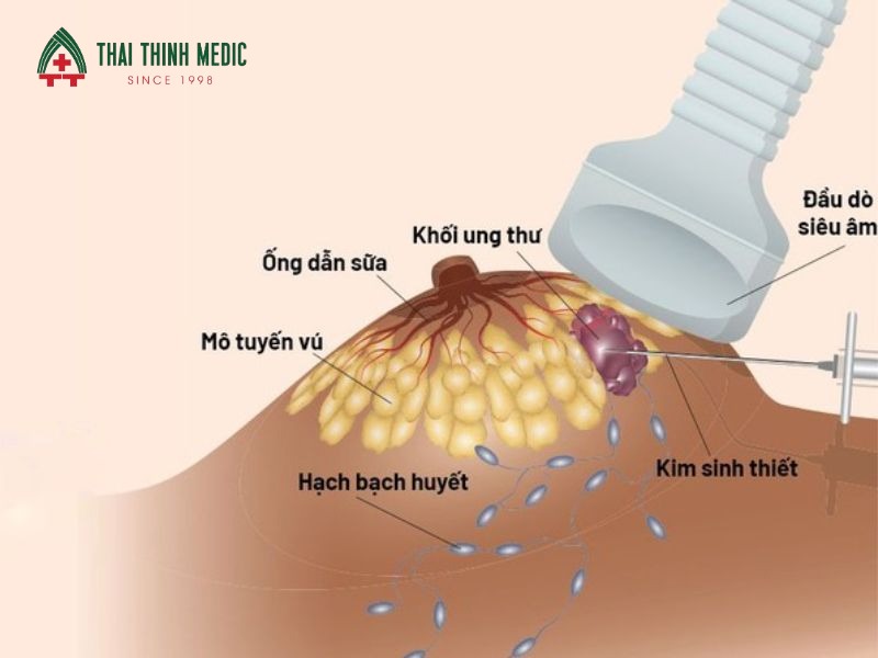 bi-rads-la-gi-sinh-thiet