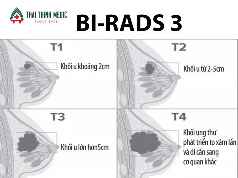 bi-rads-la-gi-3