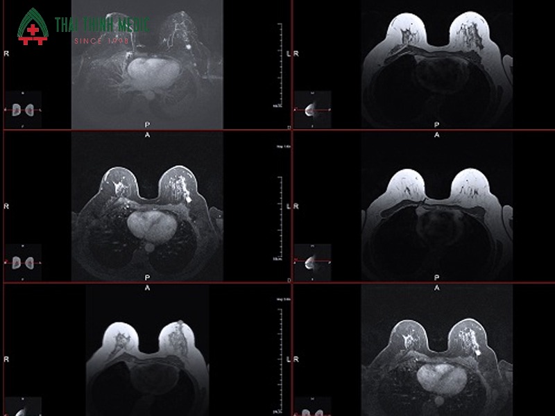 chup-mri-tuyen-vu-co-an-toan-khong