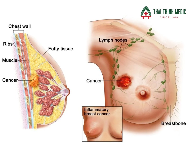 xet-nghiem-brca-ung-thu-vu