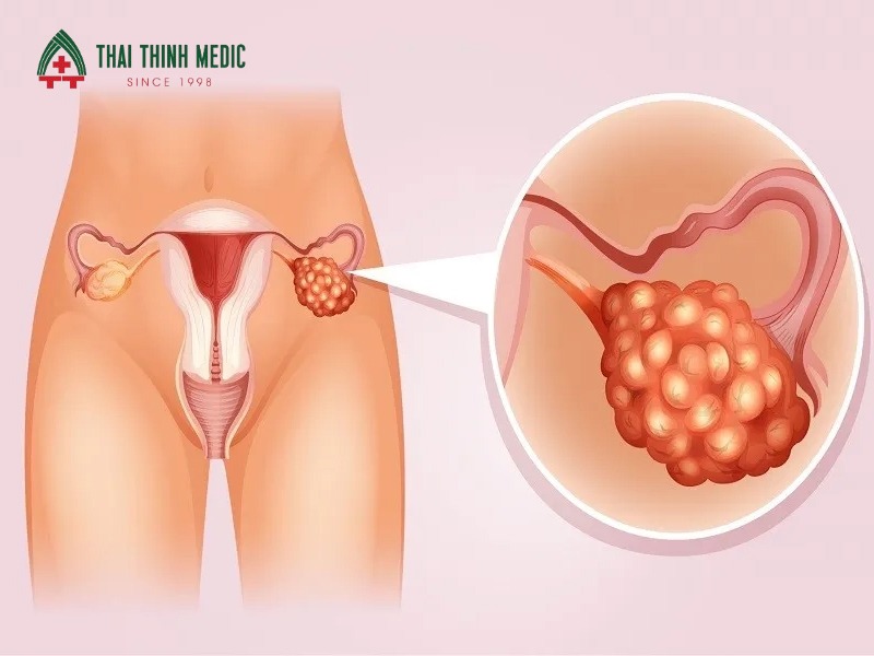 xet-nghiem-brca-theo-doi-nguy-co