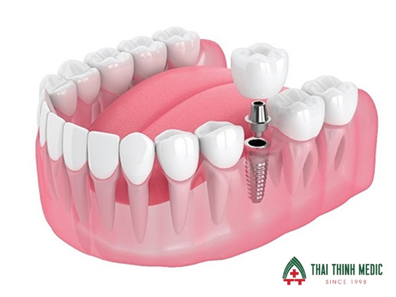 rang-ham-so-6-la-rang-nao-implant