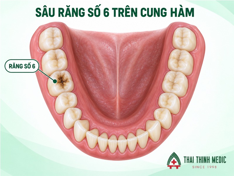 rang-ham-so-6-la-rang-nao-sau-rang