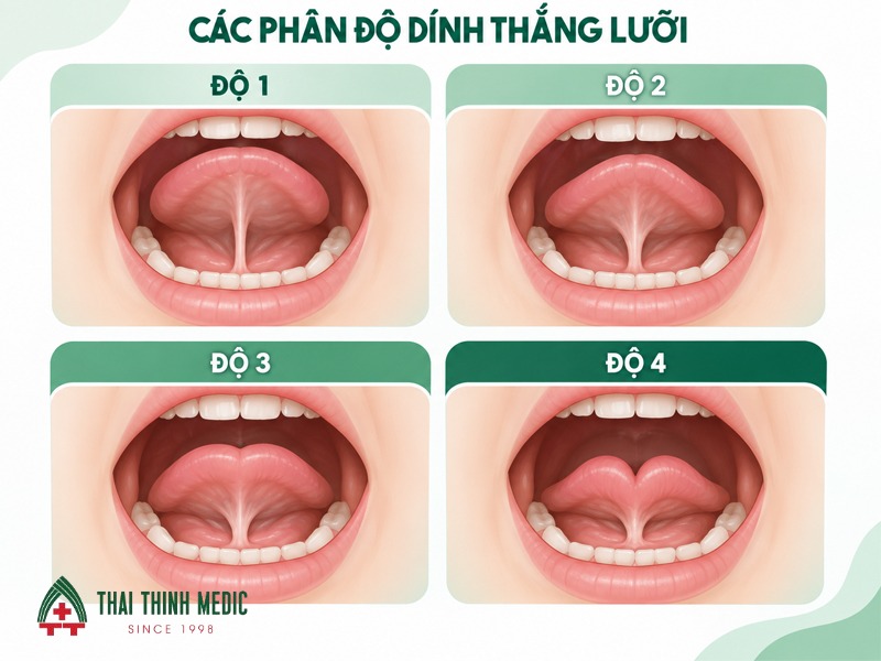 phan-do-dinh-thang-luoi-o-tre