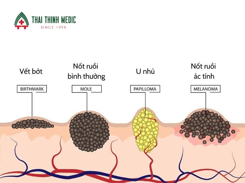 not-ruoi-ac-tinh-cau-hoi