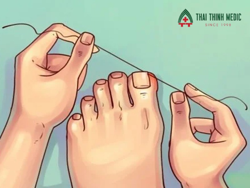 xu-ly-mong-quap-tai-nha