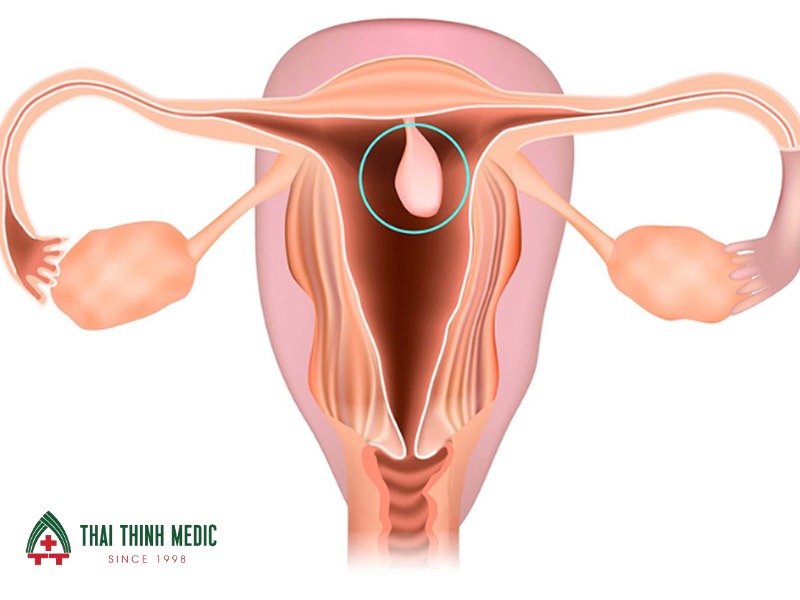 polyp-buong-tu-cung