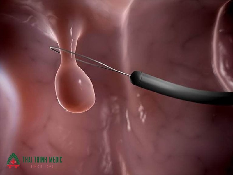 noi-soi-polyp-buong-tu-cung