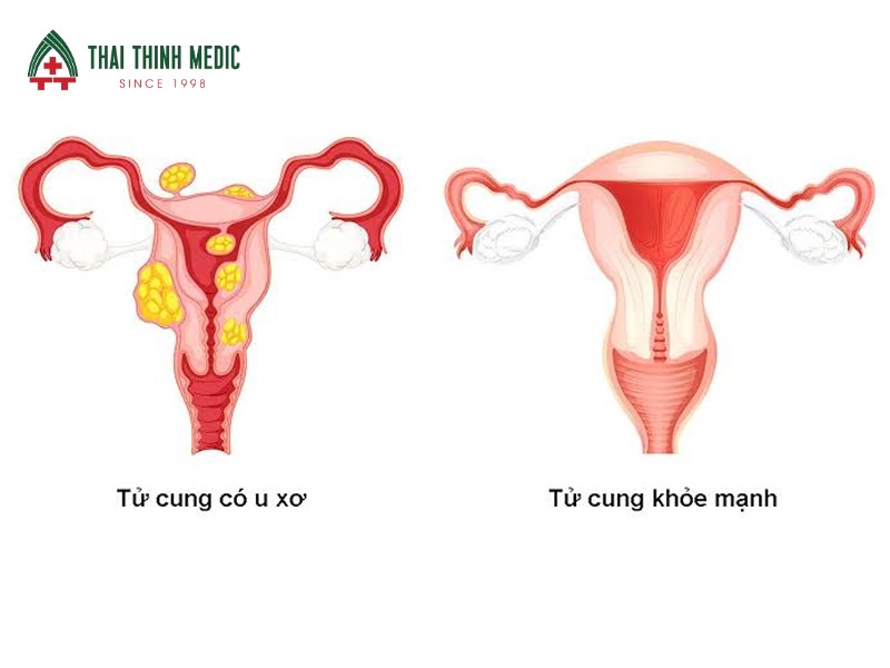 u-xo-tu-cung