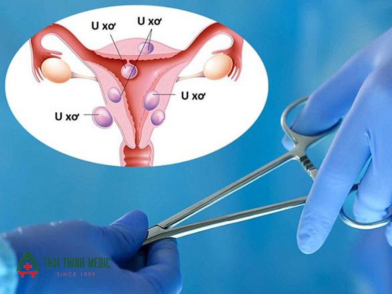 u-xo-tu-cung-boc-u