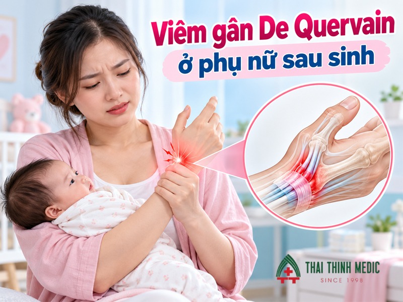 viem-gan-de-quervain-o-phu-nu-co-thai