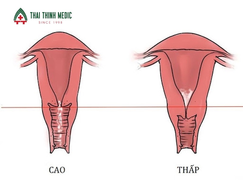 co-tu-cung-ngan-doa-sinh-non