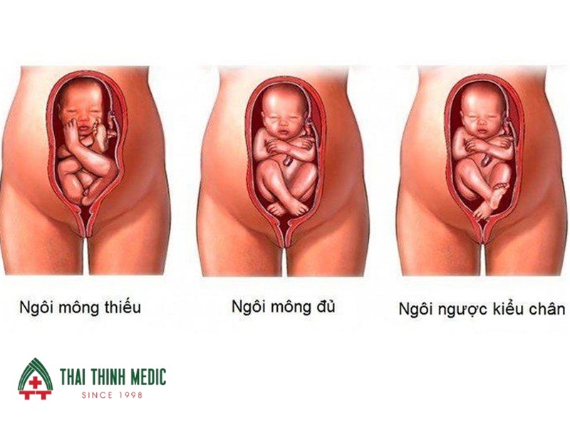 ngoi-thai-nguoc-kieu-mong