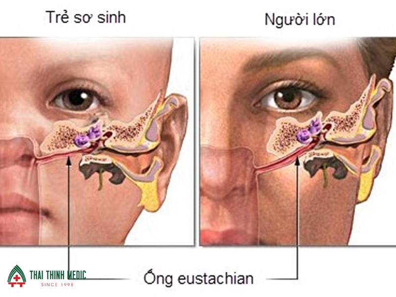 Bệnh viêm tai giữa cấp là gì? Triệu chứng và cách điều trị
